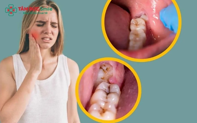 Đau nhức, sưng nướu và khó há miệng là những dấu hiệu cảnh báo phổ biến khi răng khôn bắt đầu mọc.