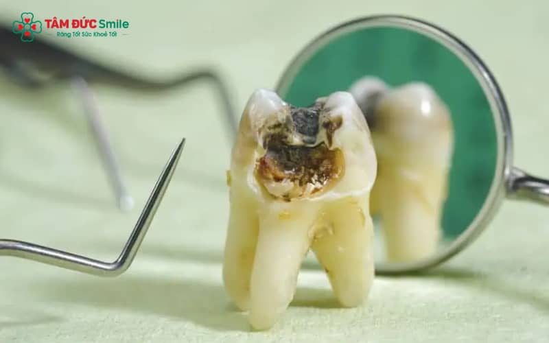 Răng khôn nằm sâu trong cung hàm, khó vệ sinh nên dễ bị sâu vỡ, đặc biệt khi mọc lệch hoặc không được điều trị sớm