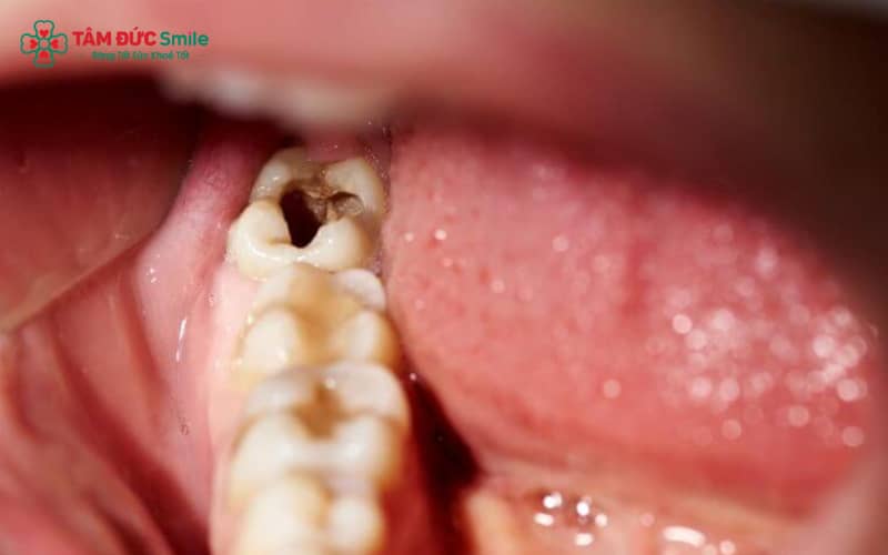 Tùy mức độ sâu vỡ, răng khôn có thể được trám, điều trị tủy hoặc chỉ định nhổ bỏ để ngăn ngừa biến chứng