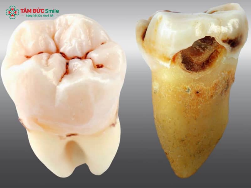 Răng khôn bị sâu vỡ: Nguyên nhân, cách điều trị và lưu ý khi nhổ răng khôn bị sâu vỡ