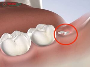 Răng khôn có nên nhổ không? Khi nào nên nhổ, trường hợp không nên và ảnh hưởng sau nhổ