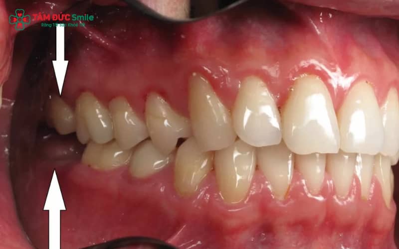 Răng khôn mọc đúng thường mọc thẳng, không gây đau nhức, không viêm nướu và không làm xô lệch các răng kế cận