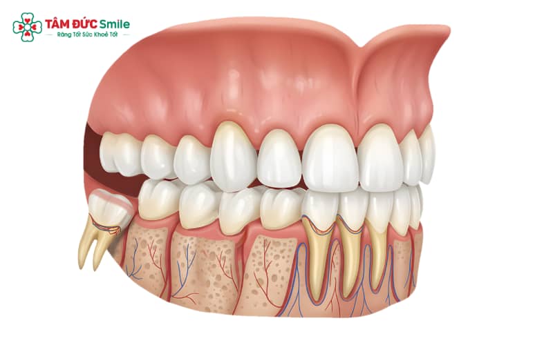 Răng khôn mọc đúng thường không nguy hiểm, tuy nhiên vẫn có nguy cơ sâu răng hoặc viêm nướu nếu không được theo dõi và vệ sinh tốt
