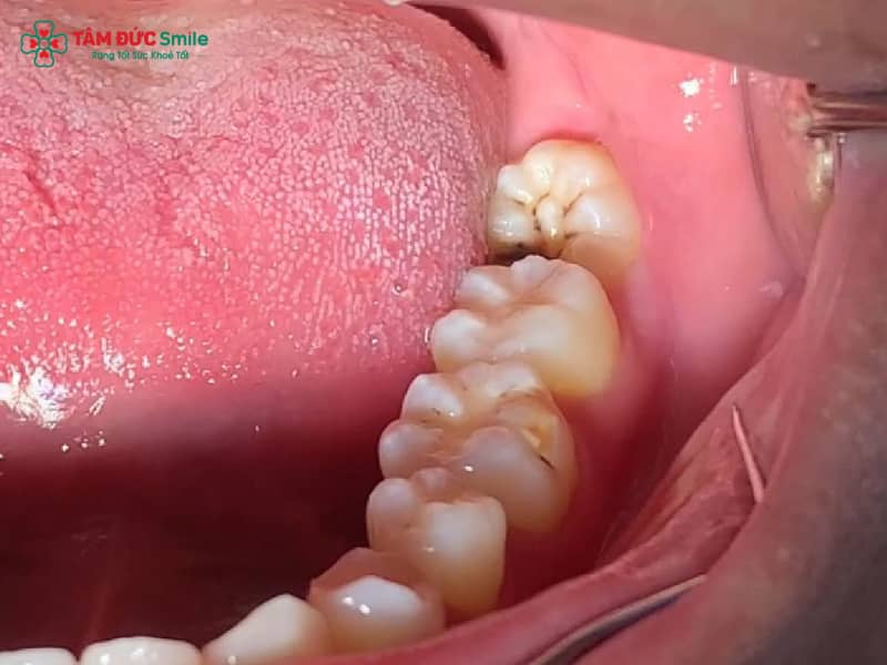 Răng khôn mọc đúng là như thế nào? Dấu hiệu, có cần nhổ không, cách theo dõi