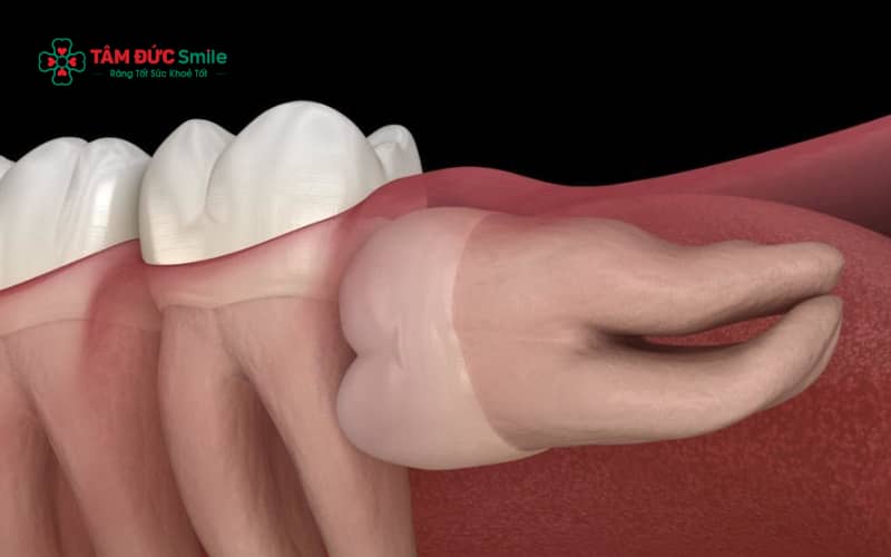 Răng khôn mọc lệch 90 độ có thể gây đau nhức kéo dài, viêm nhiễm tái phát và ảnh hưởng trực tiếp đến các răng kế cận nếu không điều trị