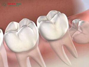 Răng khôn mọc lệch nhưng không đau khiến nhiều người băn khoăn có nên nhổ răng khôn mọc lệch hay chỉ theo dõi. Trên thực tế, răng khôn mọc lệch có nguy hiểm không còn phụ thuộc vào hướng mọc, vị trí răng khôn mọc lệch hàm dưới, khả năng gây sâu răng số 7, viêm lợi trùm hoặc chèn dây thần kinh. Nhiều trường hợp răng khôn mọc ngầm không đau nhưng để lâu vẫn tiềm ẩn biến chứng răng khôn mọc lệch. Việc nhổ răng khôn khi chưa đau, đúng thời điểm và đúng chỉ định, sẽ giúp phòng ngừa rủi ro và tối ưu chi phí điều trị. 1. Răng khôn mọc lệch nhưng không đau có nên nhổ không? Không ít người khi phát hiện răng khôn mọc lệch nhưng không đau thường chọn cách “để đó theo dõi”, bởi nghĩ rằng chưa đau thì chưa cần nhổ. Tuy nhiên, trên thực tế nha khoa, đây lại là tình huống rất dễ bị chủ quan. Bởi lẽ, răng khôn mọc lệch vốn đã là một răng có nguy cơ cao. Việc chưa xuất hiện đau nhức chỉ cho thấy răng chưa gây viêm cấp, chứ không có nghĩa là răng đang “an toàn”. Trong giai đoạn này, vi khuẩn vẫn có thể âm thầm tích tụ quanh thân răng, đặc biệt ở những vị trí khó làm sạch bằng bàn chải thông thường. Theo các bác sĩ, câu hỏi quan trọng không phải là “răng có đau hay không”, mà là: Răng khôn đang mọc lệch theo hướng nào Có tác động đến răng số 7 kế cận hay không Có tiềm ẩn nguy cơ biến chứng về sau hay không Vì vậy, với nhiều trường hợp, dù răng khôn mọc lệch nhưng không đau, bác sĩ vẫn có thể chỉ định nhổ sớm nhằm phòng tránh các vấn đề răng miệng phức tạp về sau. 2. Những tác hại tiềm ẩn khi răng khôn mọc lệch nhưng không đau Việc giữ lại răng khôn mọc lệch nhưng không đau trong thời gian dài có thể dẫn đến nhiều biến chứng, thường chỉ được phát hiện khi đã trở nên nghiêm trọng. 2.1. Sâu răng số 7 kế cận Răng khôn mọc lệch thường tạo ra khe giắt thức ăn giữa răng số 7 và răng số 8. Do vị trí sâu và khuất, việc vệ sinh rất khó triệt để, lâu ngày dẫn đến sâu răng số 7. Điều đáng nói là, khi phát hiện thì: Tổn thương sâu thường đã lan rộng Có nguy cơ viêm tủy Thậm chí phải điều trị hoặc mất răng số 7 – một răng giữ vai trò ăn nhai quan trọng 2.2. Viêm lợi trùm tái phát âm thầm Dù không gây đau ngay, răng khôn mọc lệch vẫn có thể gây viêm lợi trùm tái đi tái lại. Ban đầu chỉ là cảm giác vướng nhẹ, hơi hôi miệng hoặc nướu đỏ thoáng qua, nhưng theo thời gian, tình trạng này có thể tiến triển thành: Sưng đau dữ dội Áp xe vùng răng khôn Ảnh hưởng đến sinh hoạt và ăn nhai 2.3. Viêm quanh răng và tiêu xương ổ răng Khi vi khuẩn tồn tại lâu ngày quanh răng khôn mọc lệch, vùng xương ổ răng có thể bị viêm và tiêu xương dần dần. Lúc này, việc điều trị sẽ trở nên phức tạp hơn, quá trình nhổ răng về sau cũng khó khăn và thời gian hồi phục kéo dài. 2.4. Nguy cơ ảnh hưởng dây thần kinh răng dưới Với răng khôn mọc lệch hàm dưới, vị trí răng thường nằm gần dây thần kinh răng dưới. Nếu để đến khi có biến chứng mới xử lý, nguy cơ: Đau lan vùng hàm, tai, đầu Tê môi, tê cằm tạm thời Sẽ cao hơn so với việc nhổ sớm khi răng chưa viêm nhiễm. 3. Quy trình thăm khám và chỉ định nhổ răng khôn mọc lệch Không phải mọi trường hợp răng khôn mọc lệch nhưng không đau đều cần nhổ ngay. Quyết định đúng cần dựa trên thăm khám kỹ lưỡng và chẩn đoán hình ảnh. 3.1. Thăm khám lâm sàng Bác sĩ sẽ đánh giá tình trạng răng khôn, nướu xung quanh, mức độ khó vệ sinh cũng như dấu hiệu ảnh hưởng đến răng kế cận. 3.2. Chụp CT Cone Beam 3D Phim CT Cone Beam 3D giúp xác định chính xác: Hướng mọc và mức độ lệch của răng Khoảng cách giữa răng khôn và dây thần kinh răng dưới Nguy cơ biến chứng nếu giữ lại răng 3.3. Tư vấn nhổ hay theo dõi Dựa trên kết quả thăm khám, bác sĩ sẽ tư vấn: Nhổ răng khôn sớm nếu có nguy cơ ảnh hưởng răng số 7 hoặc mô quanh răng Theo dõi định kỳ nếu răng lệch nhẹ và chưa gây vấn đề Tại Nha khoa Tâm Đức Smile, việc chỉ định luôn đặt yếu tố an toàn và lợi ích lâu dài cho người bệnh lên hàng đầu. 4. Nhổ răng khôn mọc lệch an toàn tại Nha khoa Tâm Đức Smile Nhổ răng khôn mọc lệch là thủ thuật đòi hỏi bác sĩ có kinh nghiệm và trang thiết bị hỗ trợ đầy đủ. Nếu thực hiện đúng kỹ thuật, đặc biệt ở giai đoạn răng chưa viêm đau, quá trình nhổ sẽ nhẹ nhàng và hồi phục nhanh hơn. Tại Nha khoa Tâm Đức Smile: Bác sĩ răng hàm mặt trực tiếp thăm khám và điều trị Ứng dụng CT Cone Beam 3D để kiểm soát hướng nhổ an toàn Quy trình nhổ răng khôn được thực hiện cẩn thận, hạn chế xâm lấn Giúp giảm sưng đau và biến chứng sau nhổ Thực tế cho thấy, nhổ răng khôn mọc lệch khi chưa đau thường đơn giản hơn rất nhiều so với khi răng đã viêm nặng, vừa tiết kiệm thời gian điều trị, vừa giảm rủi ro không mong muốn.