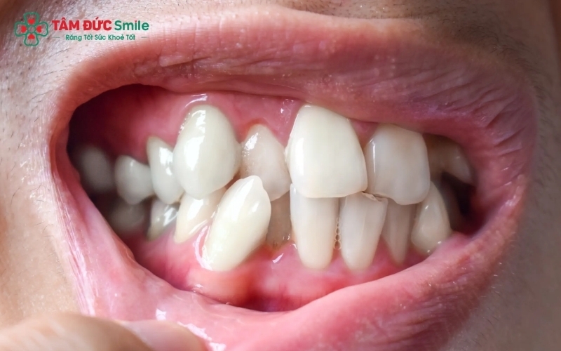 Răng mọc lệch khiến nụ cười thiếu cân đối và gây khó khăn trong việc vệ sinh răng miệng hằng ngày.