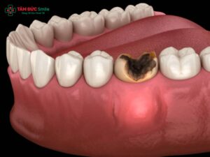 Răng sâu vỡ còn chân răng phải làm sao? Cách xử lý răng sâu vỡ nặng hiệu quả
