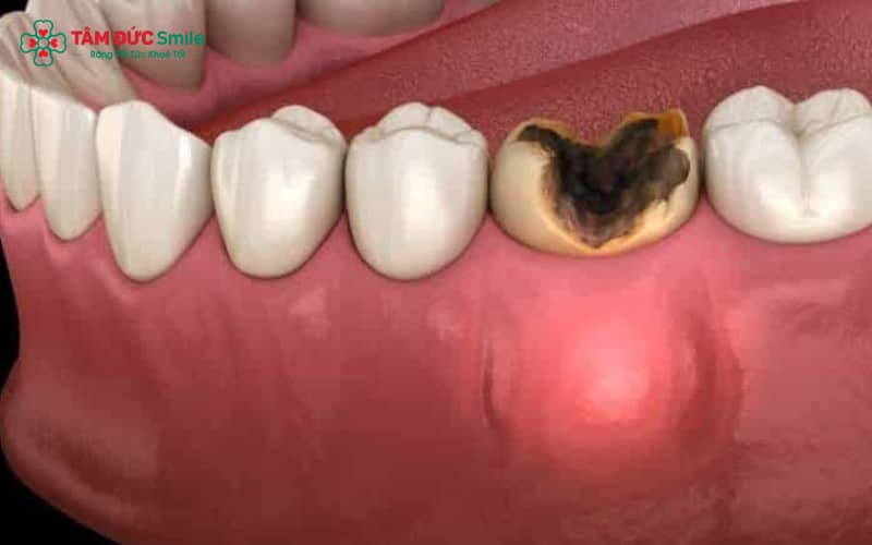 Răng số 6 có nhiều hố rãnh sâu, dễ tích tụ thức ăn và vi khuẩn