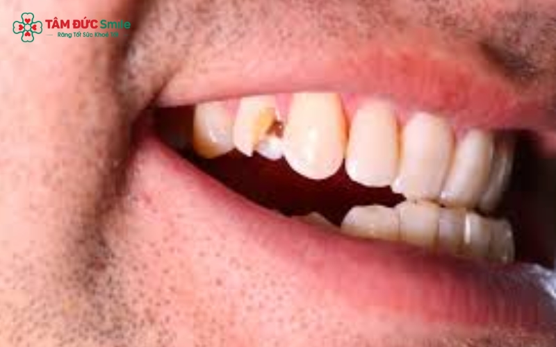 Răng số 6 bị sâu vỡ không chỉ gây đau nhức khi ăn nhai mà còn làm giảm khả năng nghiền thức ăn