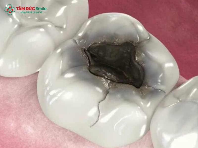 Răng số 6 bị sâu vỡ: Nguyên nhân, cách chữa, chi phí và phục hồi
