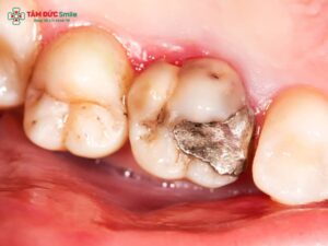 Răng số 7 bị sâu vỡ: nguyên nhân, cách điều trị và phòng ngừa