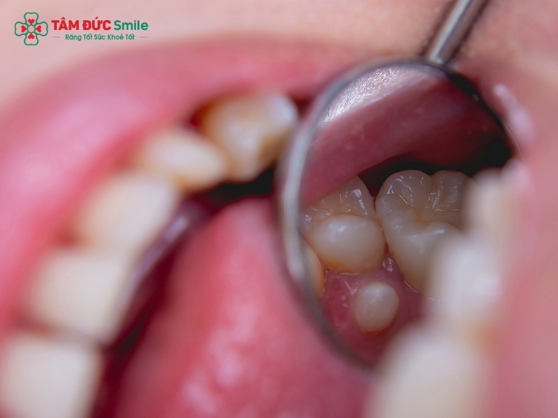 Răng thừa là gì? Răng thừa có nguy hiểm không?