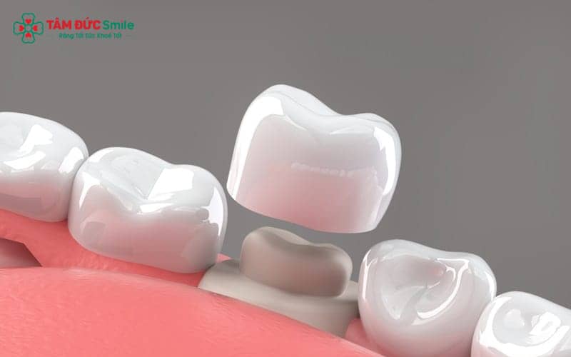 Nguyên nhân sai lầm chủ yếu đến từ tay nghề bác sĩ, vật liệu sứ kém chất lượng và quy trình lấy dấu thủ công dễ sai số