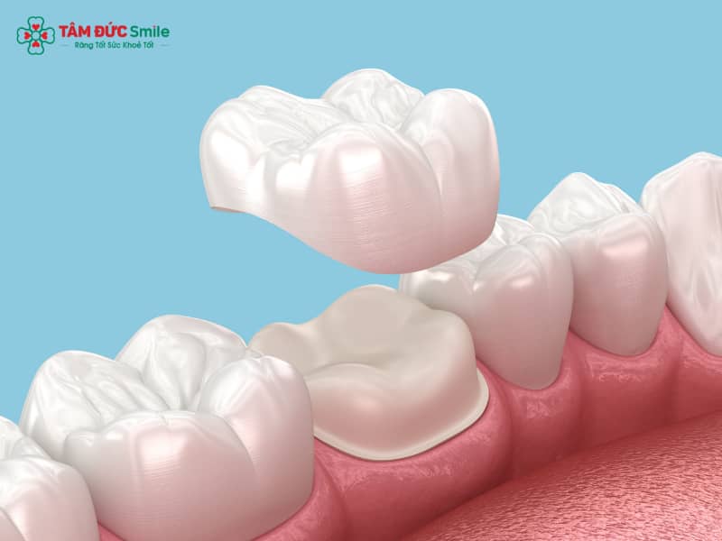 Sai lầm khi bọc răng sứ: Nguyên nhân và cách khắc phục sai lầm khi bọc răng sứ