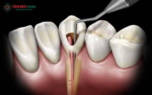 17 tuổi bọc răng sứ được không? Giải pháp an toàn cho tuổi dậy thì?
