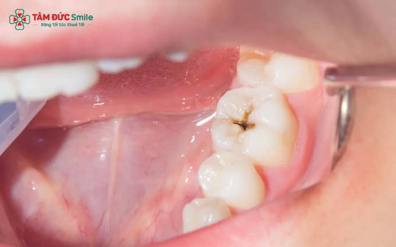 Tại sao sâu răng lại đau về đêm? Nguyên nhân đau răng, ê buốt và cách giảm đau