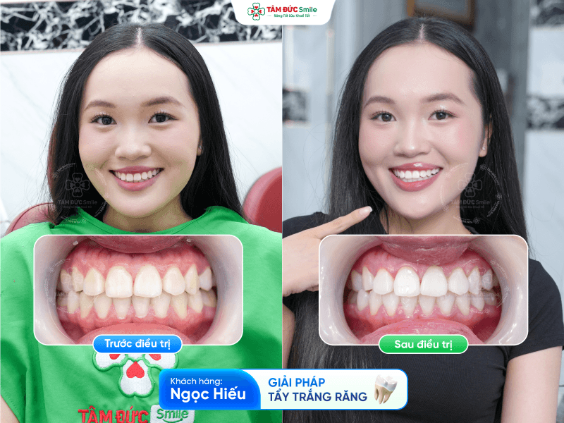 Tẩy trắng răng giúp cải thiện tình trạng răng ố vàng, xỉn màu, mang lại nụ cười sáng tự nhiên tại Nha khoa Tâm Đức Smile.