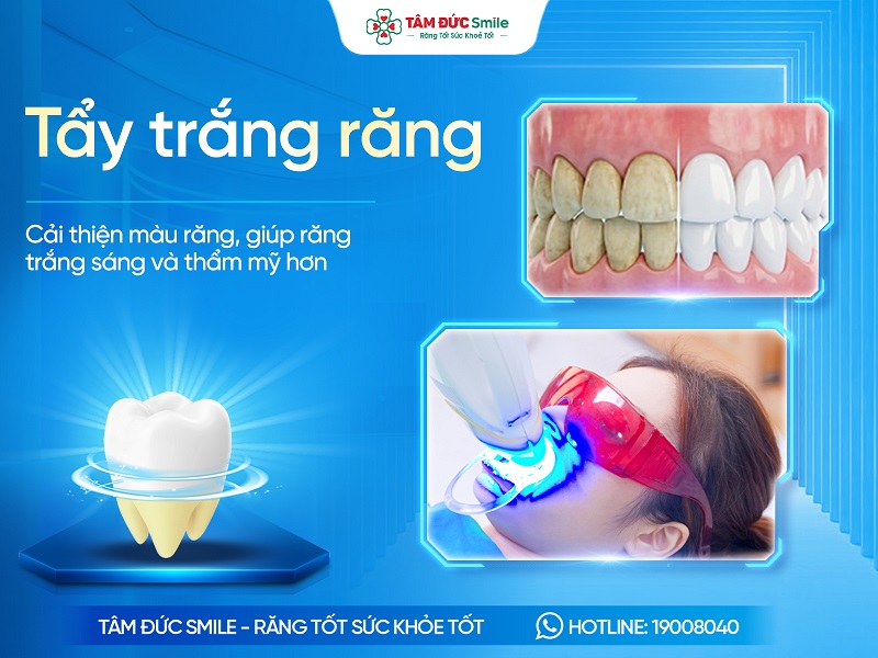 Tẩy trắng răng là gì? Phương pháp, Chi phí, Quy trình và Địa chỉ uy tín