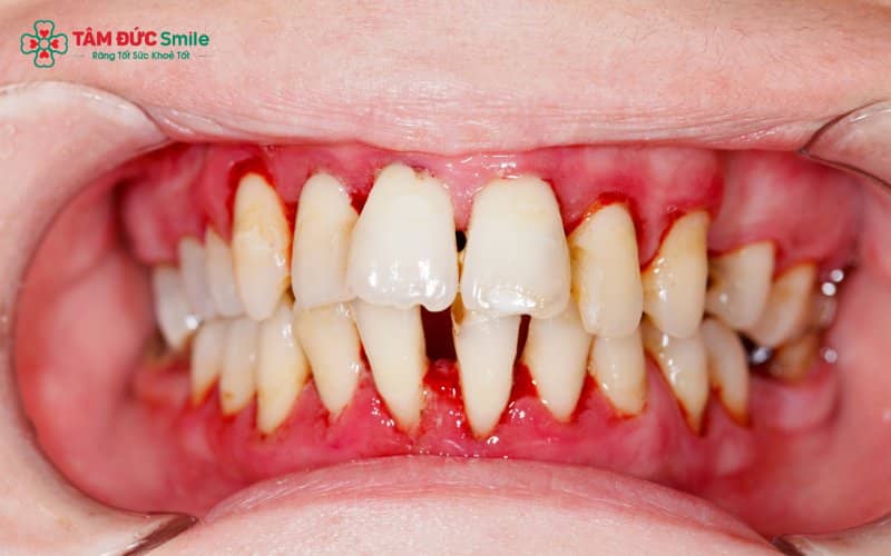 Bôi thuốc đúng vị trí – đúng liều giúp tăng hiệu quả và giảm sưng viêm nhanh hơn
