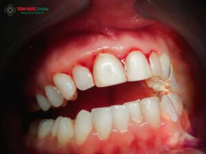 Thuốc bôi chữa viêm nha chu, gel bôi nha chu kháng viêm, giảm sưng nướu hiệu quả