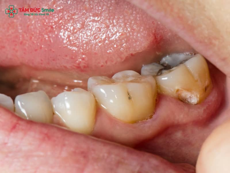 Trẻ 7 tuổi bị sâu răng hàm phải làm sao? Cách điều trị, chăm sóc và phòng ngừa hiệu quả