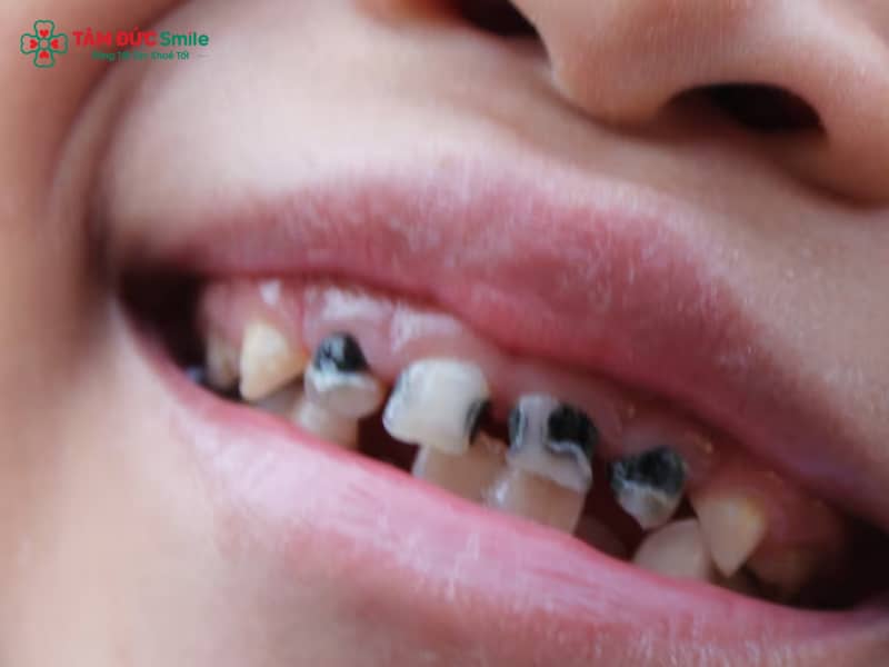Trẻ bị sâu răng hàm có mọc lại không? Dấu hiệu, nguyên nhân, cách chữa hiệu quả