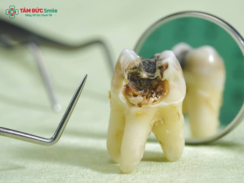Trị sâu răng vĩnh viễn tại nhà: Giảm đau nhức, viêm tủy, lỗ sâu an toàn hiệu quả