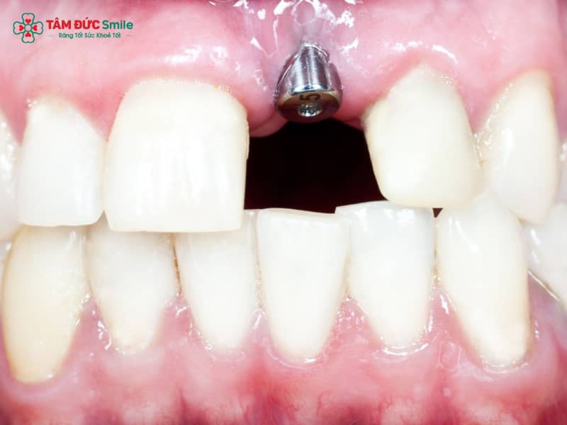 Trồng răng cửa thẩm mỹ: Implant, cầu răng sứ, phục hình răng cửa bền đẹp