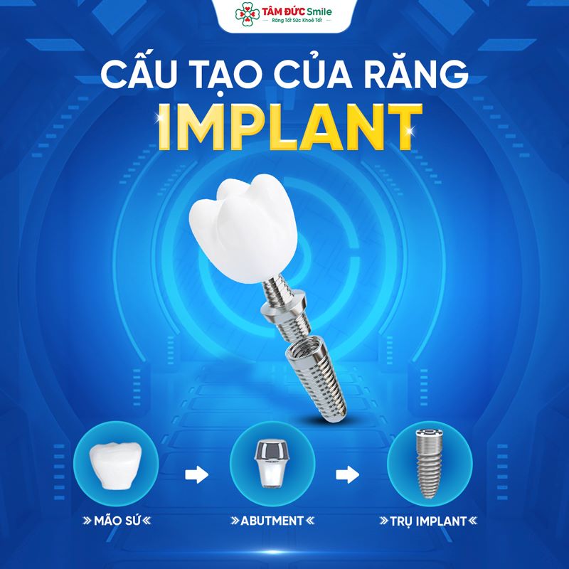 Mô phỏng cấu tạo trồng răng Implant gồm trụ Implant, Abutment và mão răng sứ tại Nha khoa Tâm Đức Smile.