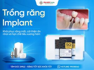 Trồng răng Implant là gì? Lợi ích, Quy trình, Chi phí và Phương pháp