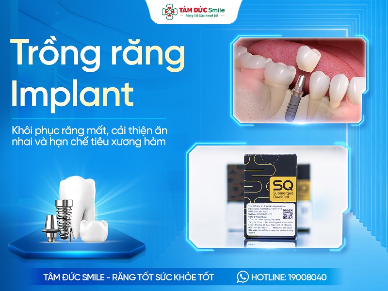 Trồng răng Implant là gì? Lợi ích, Quy trình, Chi phí và Phương pháp
