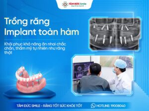 Trồng răng implant toàn hàm là gì? Phương pháp, Chi phí, Quy trình và Địa chỉ uy tín