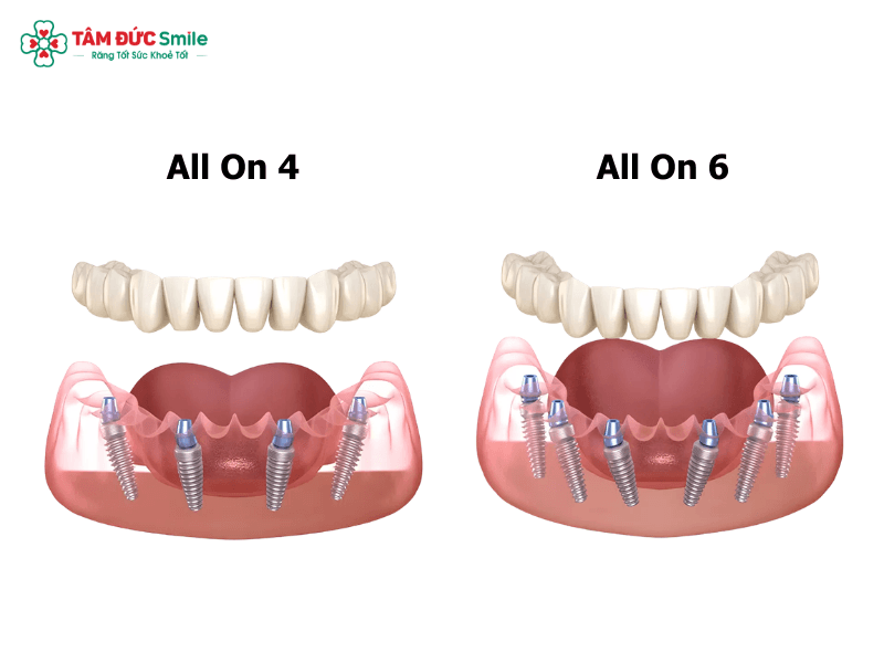 trong-rang-implant-toan-ham-2