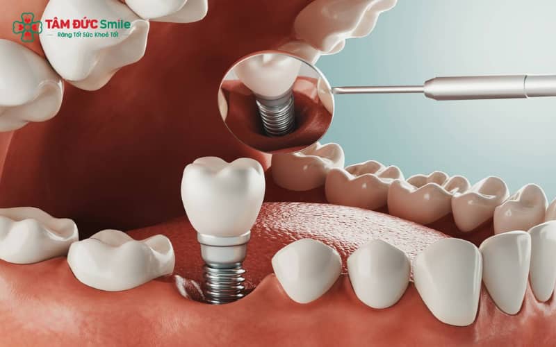 Răng số 6 là răng hàm lớn giữ vai trò chính trong ăn nhai và thường có nguy cơ mất sớm nếu không được chăm sóc đúng cách