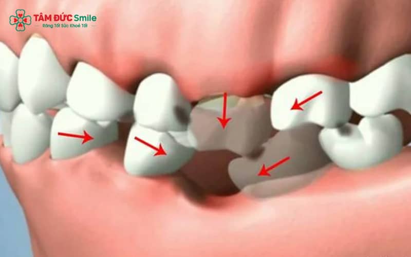 Chi phí trồng răng số 6 phụ thuộc vào phương pháp phục hình, vật liệu sử dụng và tình trạng răng miệng từng người