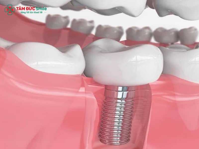 Trồng răng số 6 là gì? Giá, thời gian và các phương pháp phổ biến