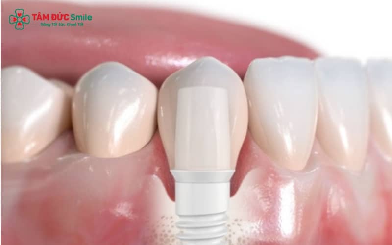 Trồng răng sứ cố định là giải pháp phù hợp cho các trường hợp răng tổn thương nặng, mất răng hoặc răng đổi màu
