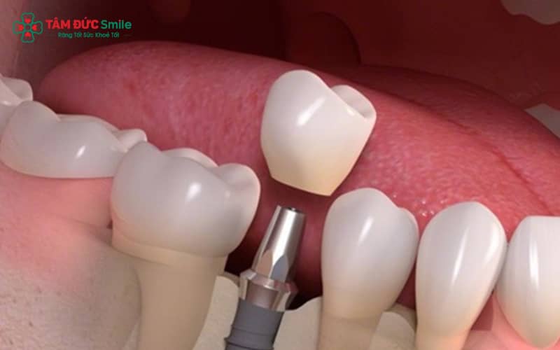Tùy tình trạng răng và nhu cầu thẩm mỹ, bác sĩ sẽ chỉ định loại răng sứ phù hợp nhằm đảm bảo độ bền, khả năng ăn nhai và tính thẩm mỹ lâu dài