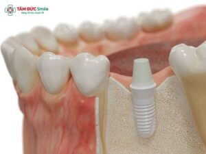 Trồng răng sứ cố định là gì? Đối tượng và các phương pháp phổ biến