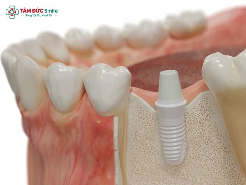Trồng răng sứ cố định là gì? Đối tượng và các phương pháp phổ biến