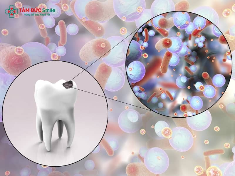 Vi khuẩn sâu răng: Nguyên nhân, dấu hiệu, cách diệt hiệu quả