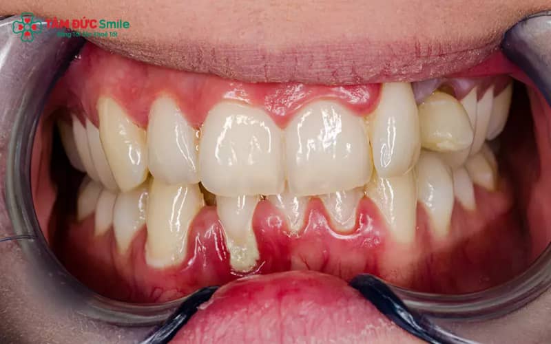 Thời gian hồi phục tùy mức độ viêm nha chu: nhẹ hồi phục sau 1–2 tuần, nặng có thể kéo dài đến vài tháng