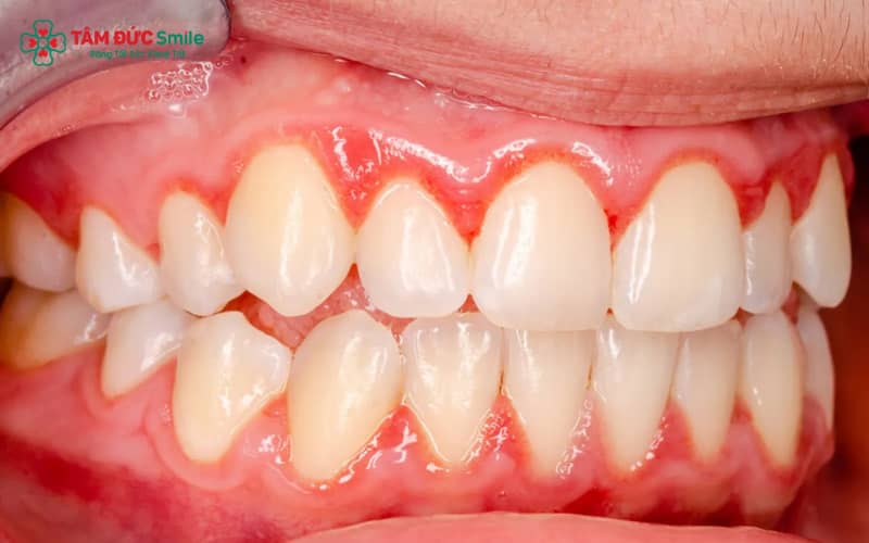 Thời gian hồi phục phụ thuộc mức độ tổn thương, thói quen chăm sóc răng miệng và khả năng đáp ứng điều trị