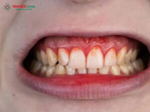 Viêm nha chu bao lâu thì khỏi? Thời gian điều trị, phác đồ và dấu hiệu hồi phục