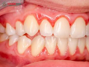 Viêm nha chu có niềng răng được không? Giải pháp an toàn