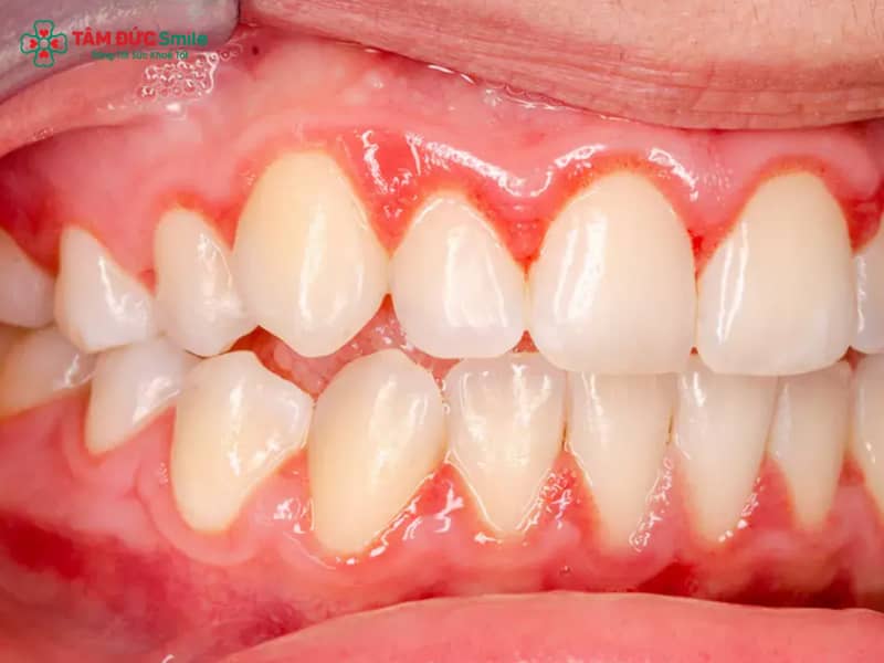 Viêm nha chu có niềng răng được không? Giải pháp an toàn