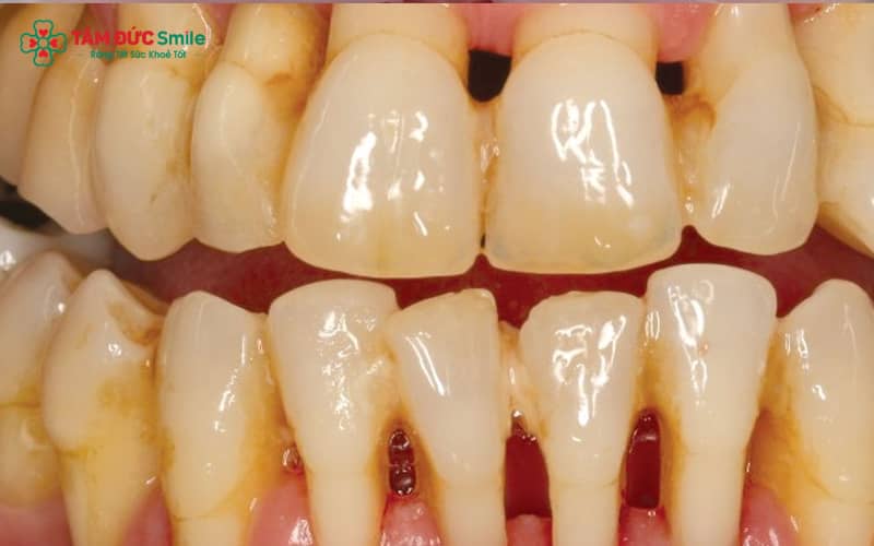 Túi nha chu sâu và tiêu xương ổ răng – dấu hiệu điển hình của viêm nha chu nặng
