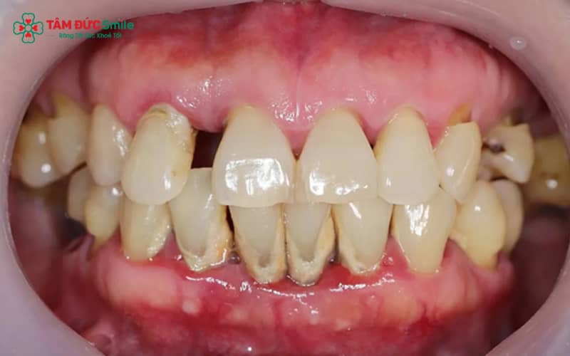 Mảng bám và cao răng không được làm sạch là nguyên nhân hàng đầu khiến viêm nha chu tiến triển nặng