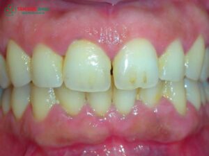 Viêm nha chu nặng: Dấu hiệu, nguyên nhân, điều trị và phục hồi
